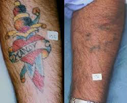 Best Laser Treatment for Tattoo Removal | Styles At Life