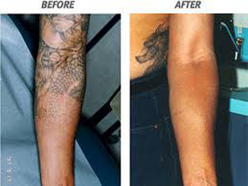 9 Best Laser Tattoo Removal Treatments | Styles At Life