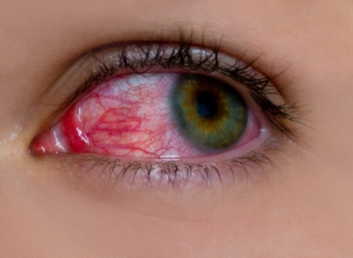 Glaucoma Symptoms And Causes Styles At Life