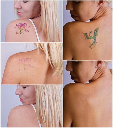 13 Tattoo Removal Methods And How To Remove Tattoo