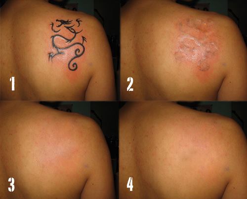 Complete Laser Tattoo Removal