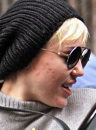 celebrities with pimples face
