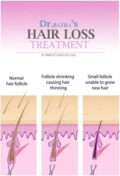 Dr Batra's Hair Loss Treatment | Styles At Life