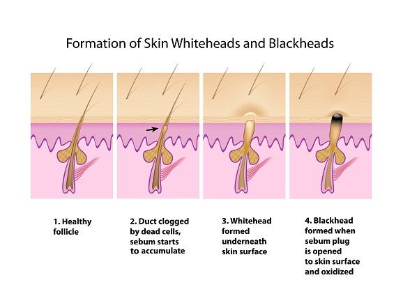 White and Black Heads