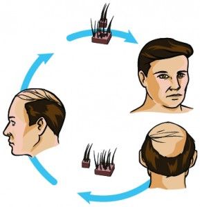 Hair Transplant In Lucknow