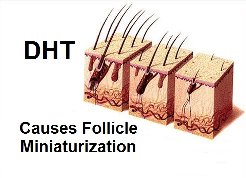 dht and hair loss in women