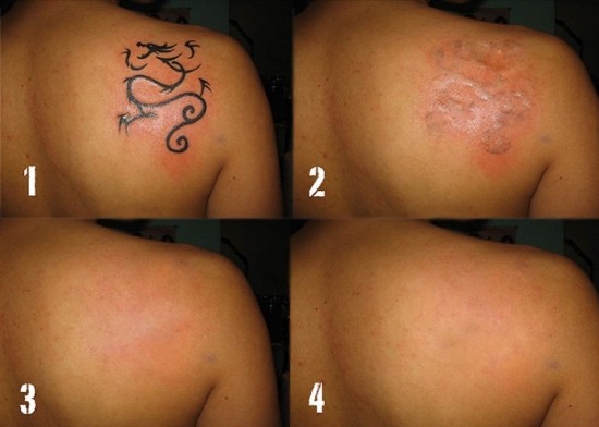 Why does tattoo removal itch and what can you do about it?