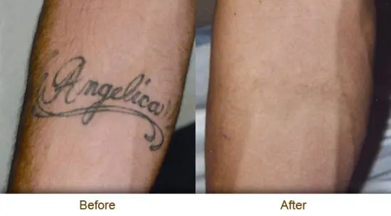 How To Remove Tattoo - 13 Best Tattoo Removal Methods