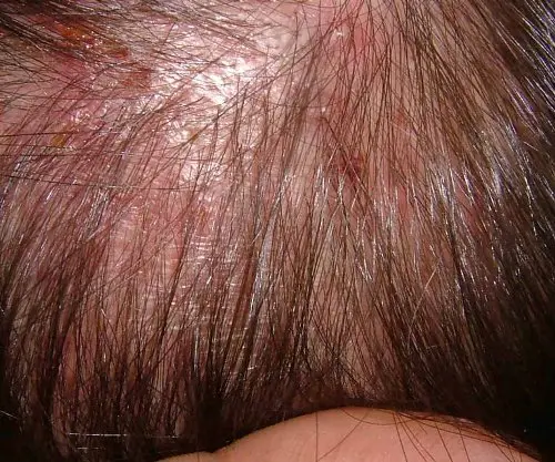Causes of Folliculitis Hair Loss – Precautions & Treatment | Styles At LIfe