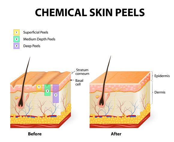Chemical Peels or Dermabrasion