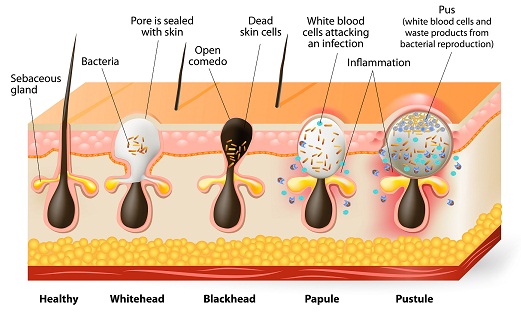 types of pimples and cures