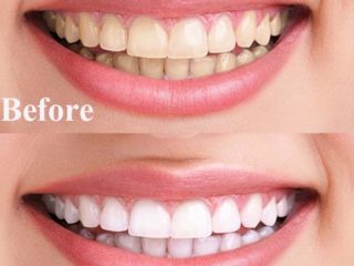 Smile Bright With These 25 Natural Teeth Whitening Remedies!