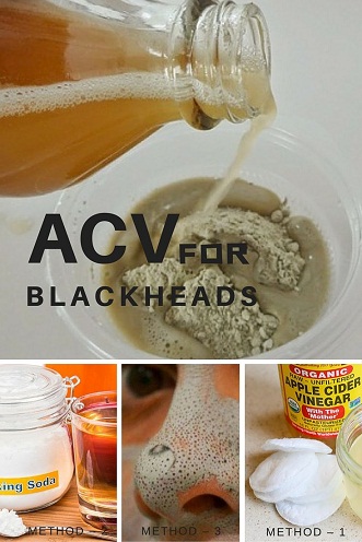 Apple Cider Vinegar for Blackheads