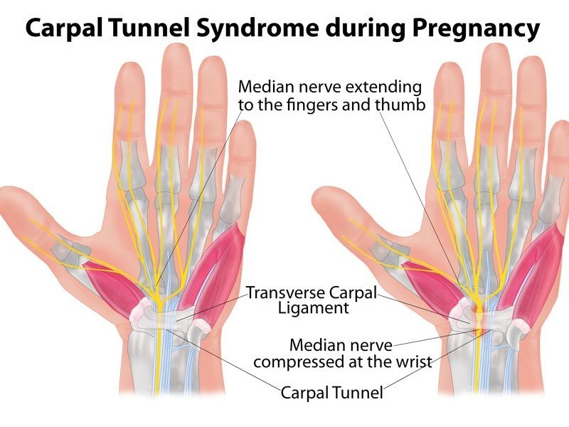 carpal tunnel syndrome during pregnancy