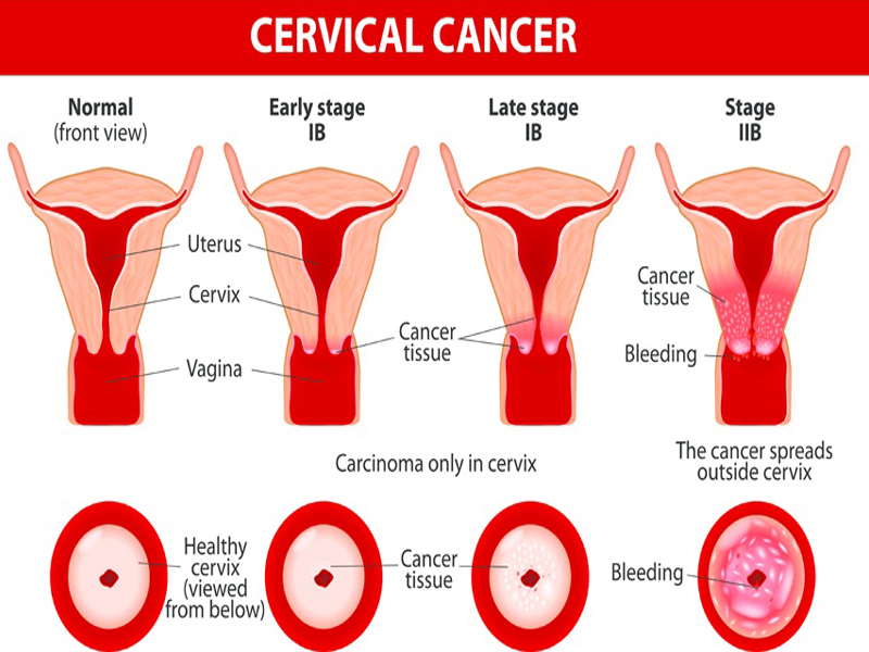 Cervical Cancer Symptoms And Causes