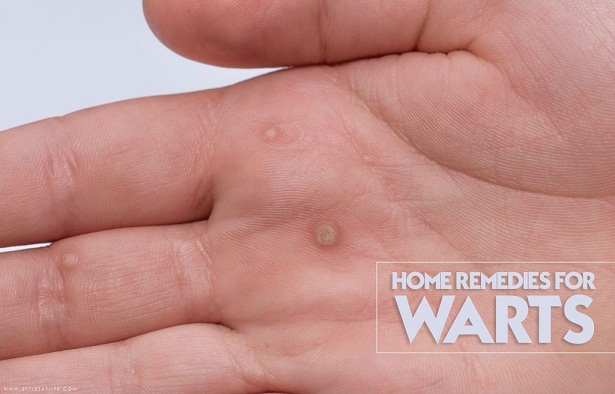 home remedies for warts