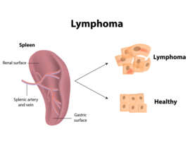 Lymphoma Symptoms And Causes