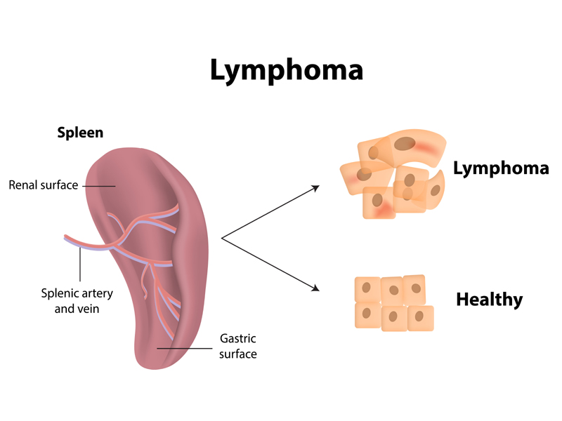 Lymphoma Symptoms