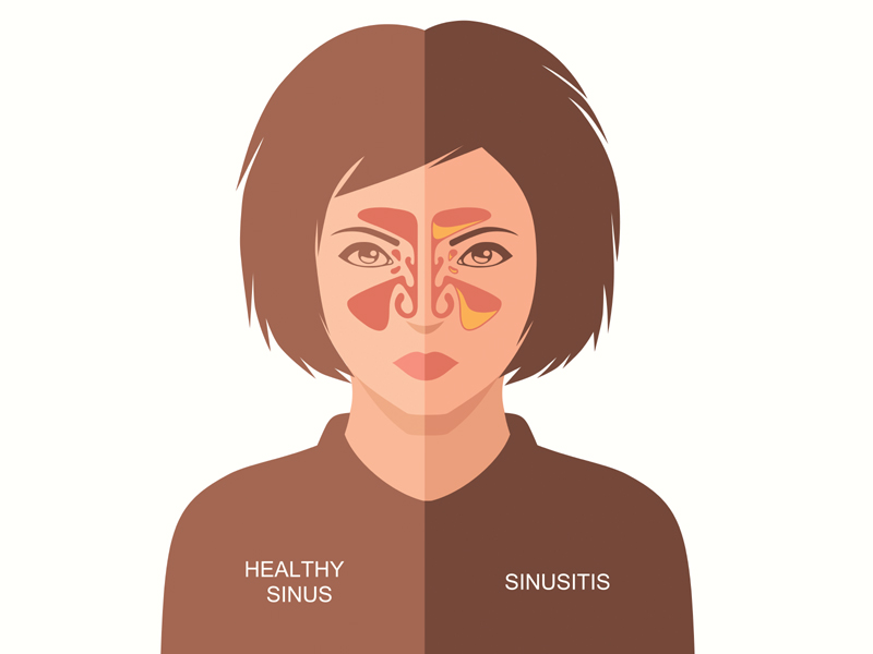 Sinus Symptoms And Causes