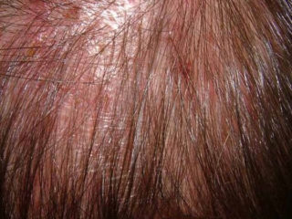 Causes of Folliculitis Hair Loss – Precautions & Treatment