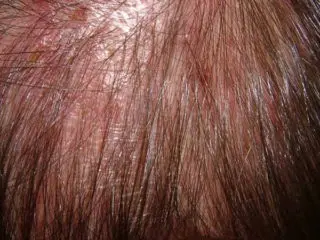 Homeopathic treatment for Alopecia Areata and Bald patches