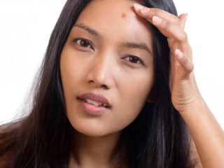 How to Get Rid of Pimples On Forehead? – Causes, Home Remedies & Treatments!