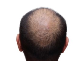 15 Best Clinics For Hair Transplant In Mumbai | Styles At Life