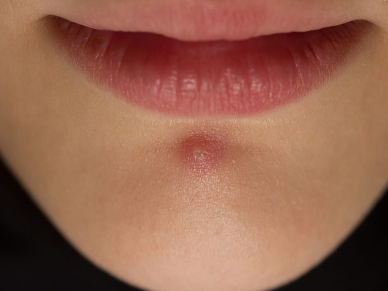  Home Remedies To Treat Pimples On Chin