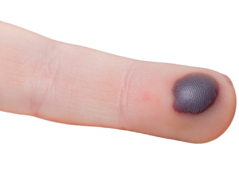 How To Get Rid Of Blood Blisters