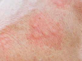 Skin Allergy Symptoms And Causes