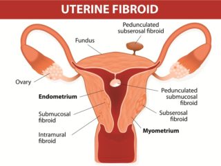 Symptoms of Fibroids