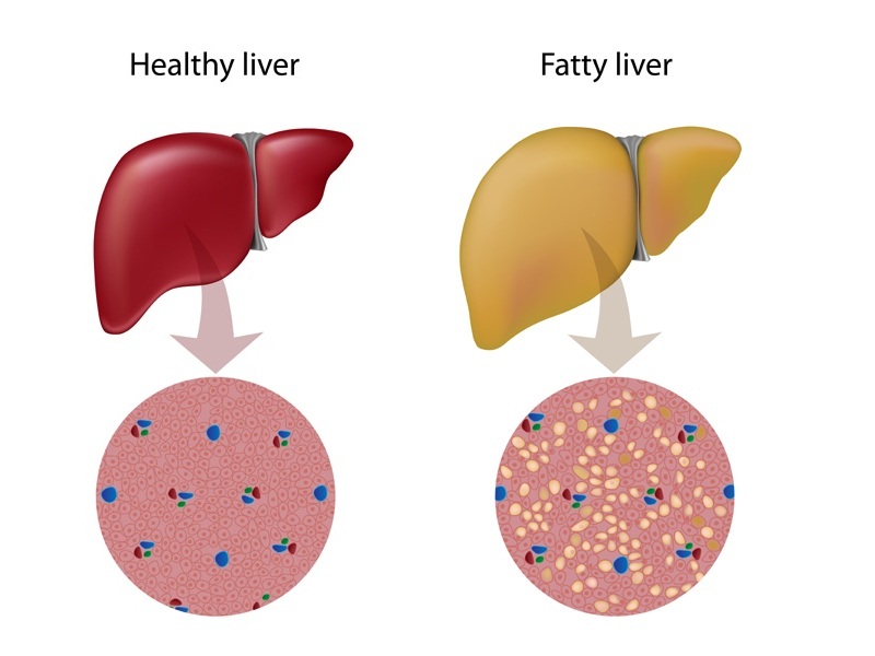 How To Reduce Fatty Liver Naturally At Home