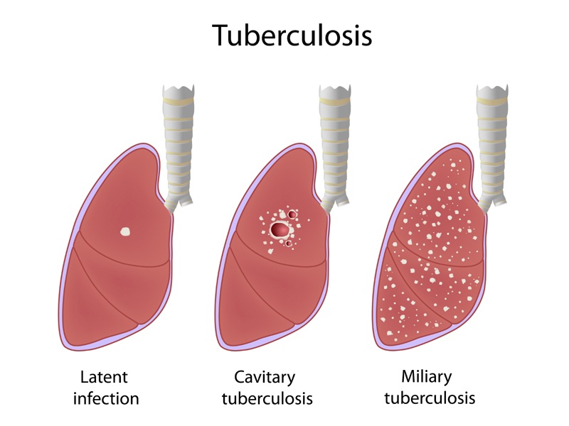 Tuberculosis (tb) Symptoms And Causes