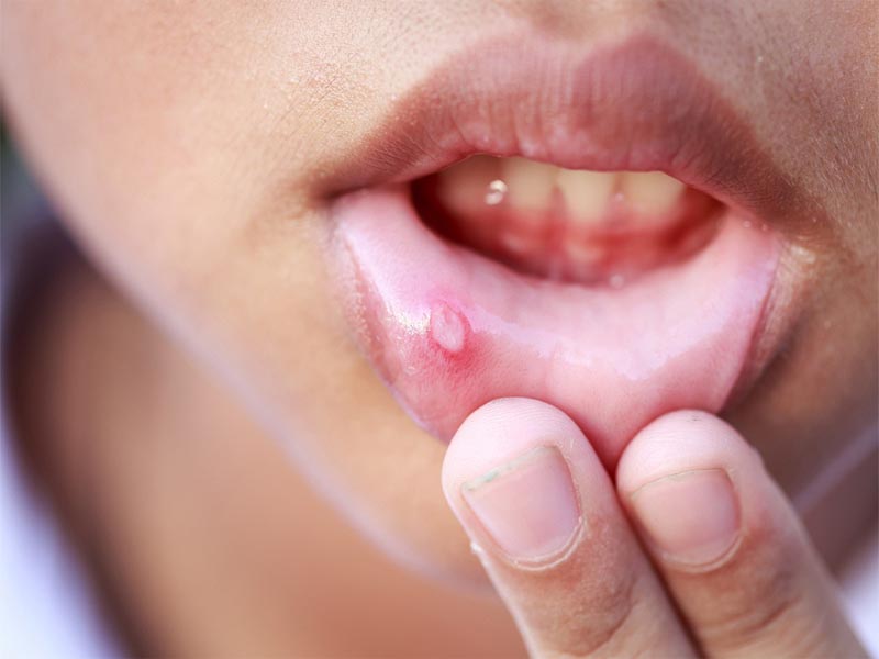 mouth ulcers during pregnancy