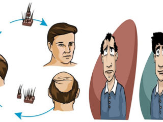 9 Best Hair Transplant Centers In Indore