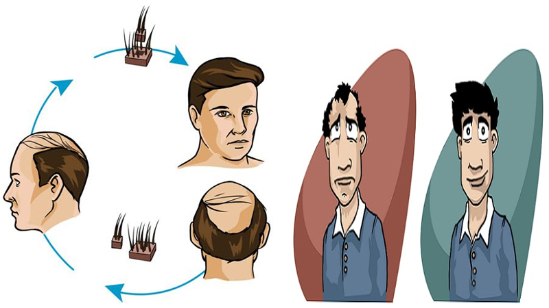 Best Hair Transplant Centers In Indore