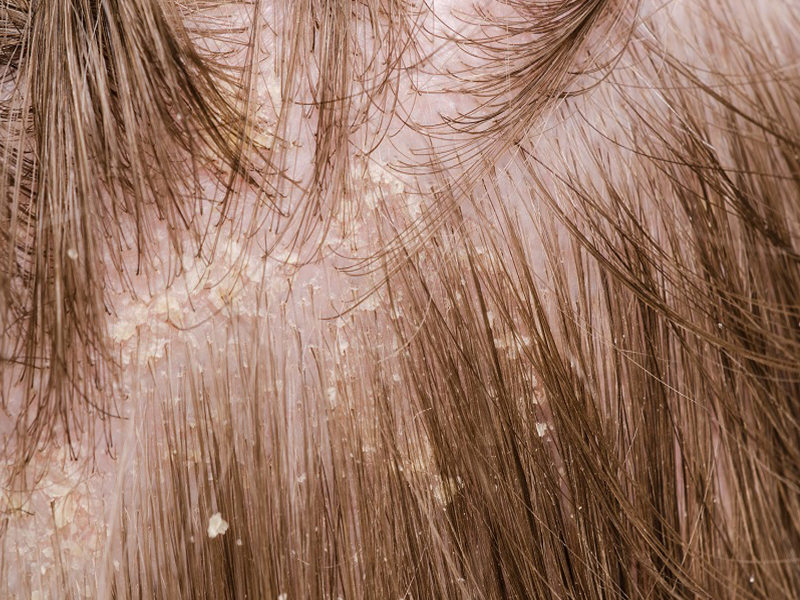 Dandruff Caused By Fungal Infection