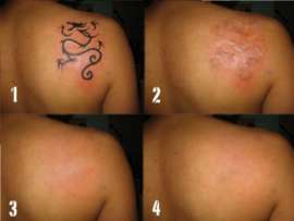 How To Remove Tattoo – 13 Best Tattoo Removal Methods!