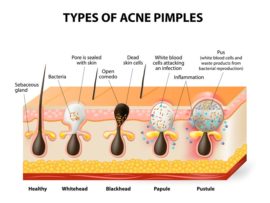 Different Types Of Pimples – How To Cure
