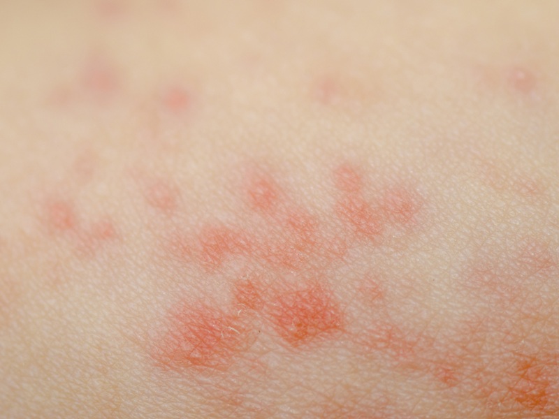 Eczema Symptoms And Causes