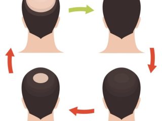 How To Tackle Hair Loss In Patches?