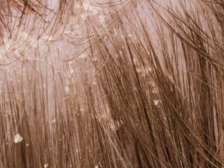How to Use Coconut Oil To Treat Dandruff? – 5 Proven Methods!