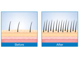 What is Laser Therapy for Hair Loss and Its Benefits!