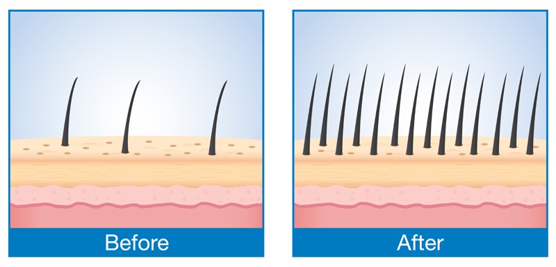 Laser Hair Treatment Copy