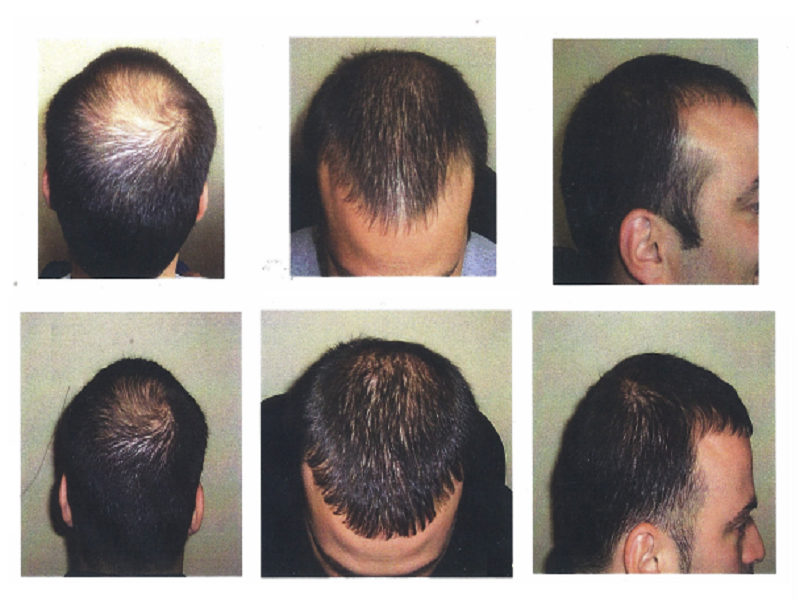 Hair Successful Treatment of Hair Loss Using Excimer Laser and Low Level Laser  Therapy Alopecia Therapy  The Skin Center BoardCertified  Dermatologists  Excellence in Medical Surgical and Pediatric Dermatology