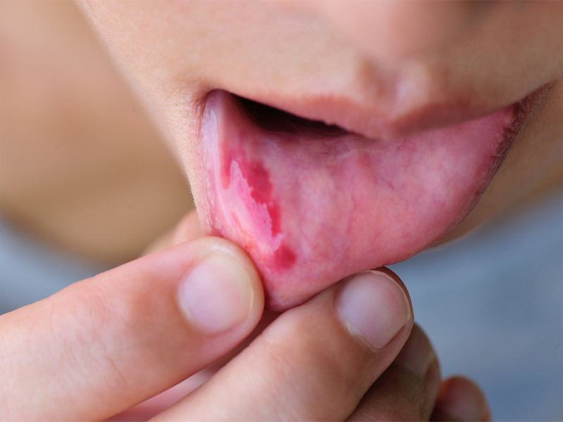 Mouth Ulcer Causes And Symptoms