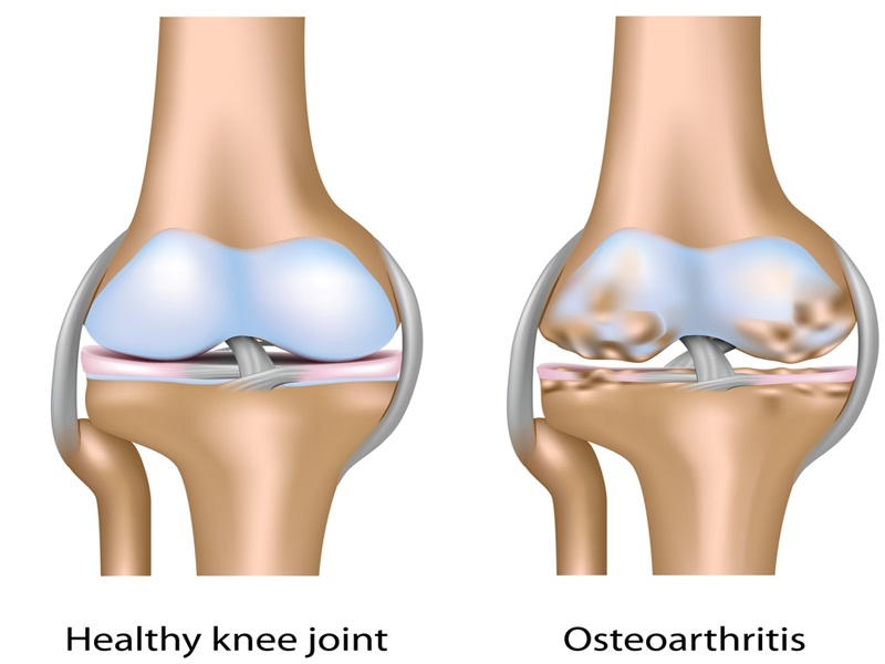 Osteoporosis Symptoms, Causes