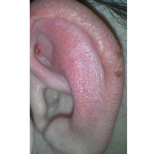 pimple in ear