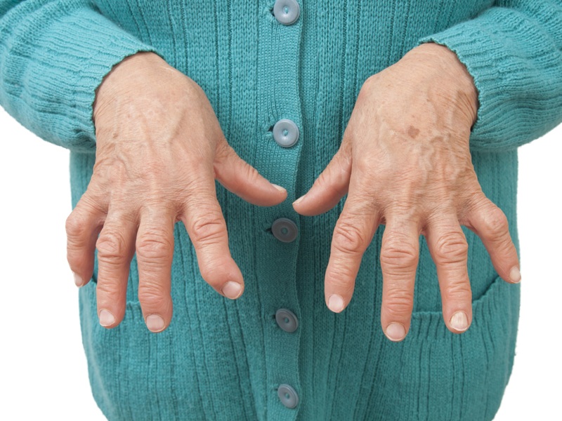 Rheumatoid Arthritis Symptoms And Causes
