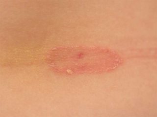 15 Best Home Remedies For Ringworm For Instant Relief.